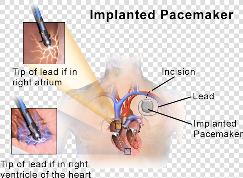 Implantable Cardioverter Defibrillators  HD Png DownloadTransparent PNG