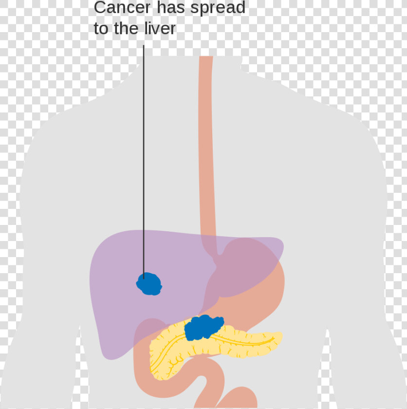 Illustration Pancreatic Cancer  HD Png DownloadTransparent PNG