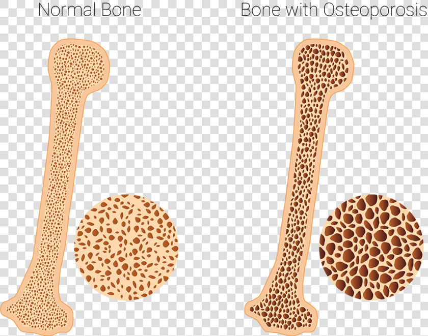 Osteoporosis Clinic   Healthy And Osteoporotic Bone  HD Png DownloadTransparent PNG