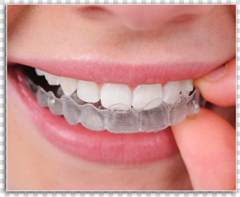 Closeup Of Patient Placing Invisalign Tray   Invisalign Braces Cost In India  HD Png DownloadTransparent PNG