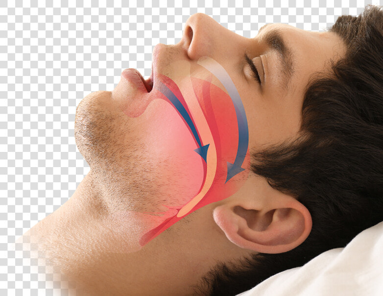 Man Sleeping   Surgery Sleep Apnea  HD Png DownloadTransparent PNG