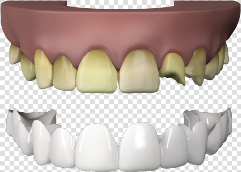 Press On Veneers Teeth   Fang  HD Png DownloadTransparent PNG