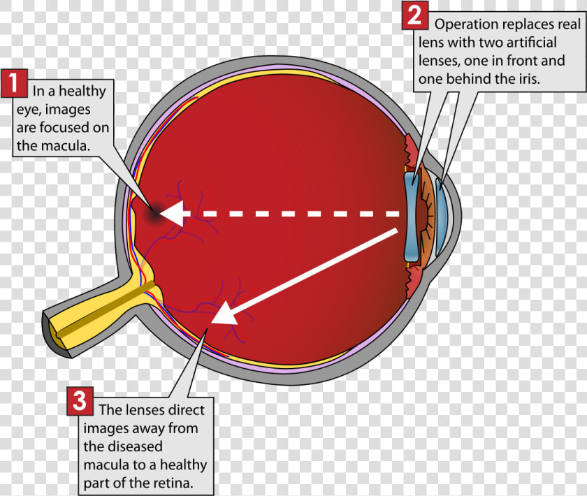 Implantable Miniature Telescope Diagram  HD Png DownloadTransparent PNG