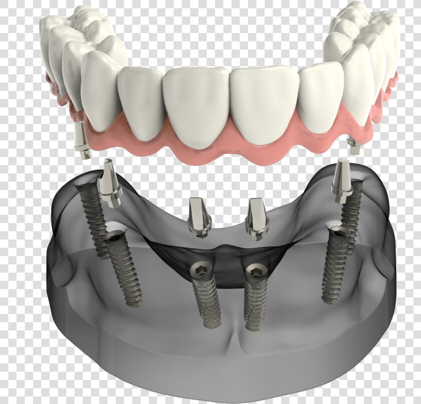 Implant Secured Denture Sudbury Ma Dentist  HD Png DownloadTransparent PNG