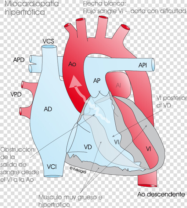 Tetralogia De Fallot Cirugia  HD Png DownloadTransparent PNG