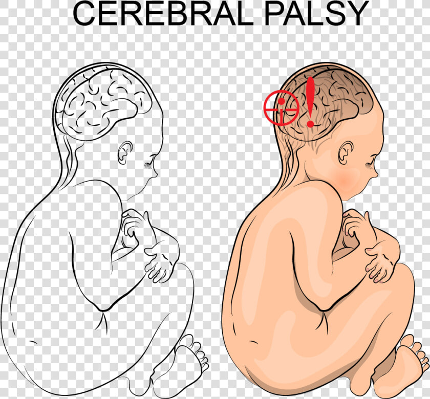 How Can I Tell If My Child Has Cerebral Palsy   Cerebral Palsy Illustration  HD Png DownloadTransparent PNG