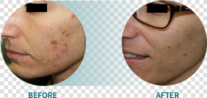 Active Acne acne Scars  HD Png DownloadTransparent PNG