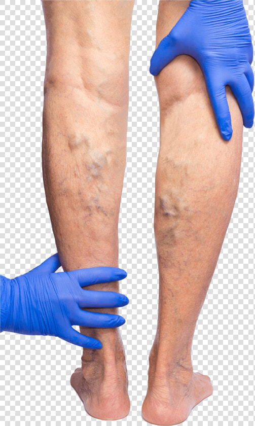 Gloved Hands Feeling The Backs Of Legs That Are Covered   Phlebitis Varicose Veins  HD Png DownloadTransparent PNG