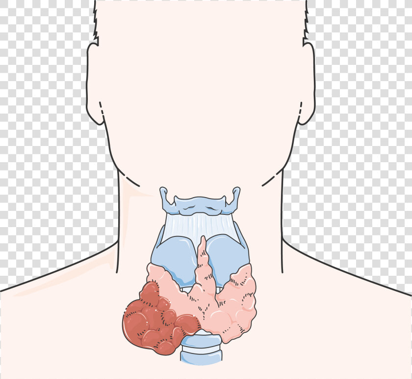 Cancer De La Thyroïde   Thyroid Cancer Cartoon  HD Png DownloadTransparent PNG