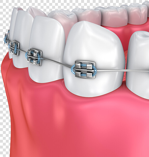 Haltom Orthodontics   Dental Braces  HD Png DownloadTransparent PNG