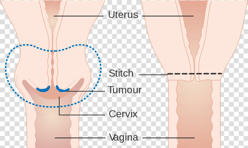 Cervical Amputation   Illustration  HD Png DownloadTransparent PNG