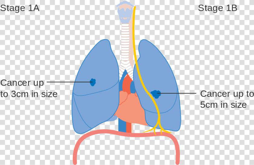 Cough Clipart Lung Cancer  HD Png DownloadTransparent PNG