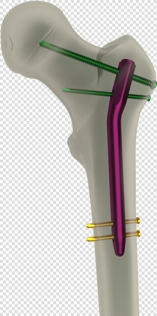 Intramedüller Femur Çivisi  HD Png DownloadTransparent PNG