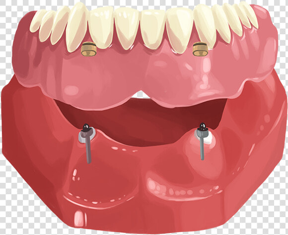 Dentures  HD Png DownloadTransparent PNG