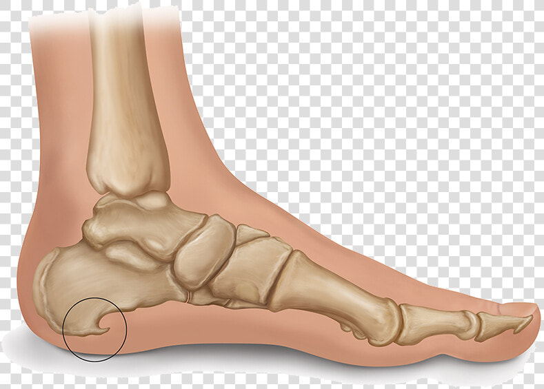 Heel Spur Illustration   عکس خار پاشنه پا  HD Png DownloadTransparent PNG