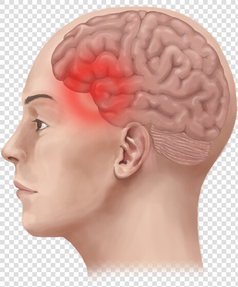 Migraine Pain In Head  HD Png DownloadTransparent PNG