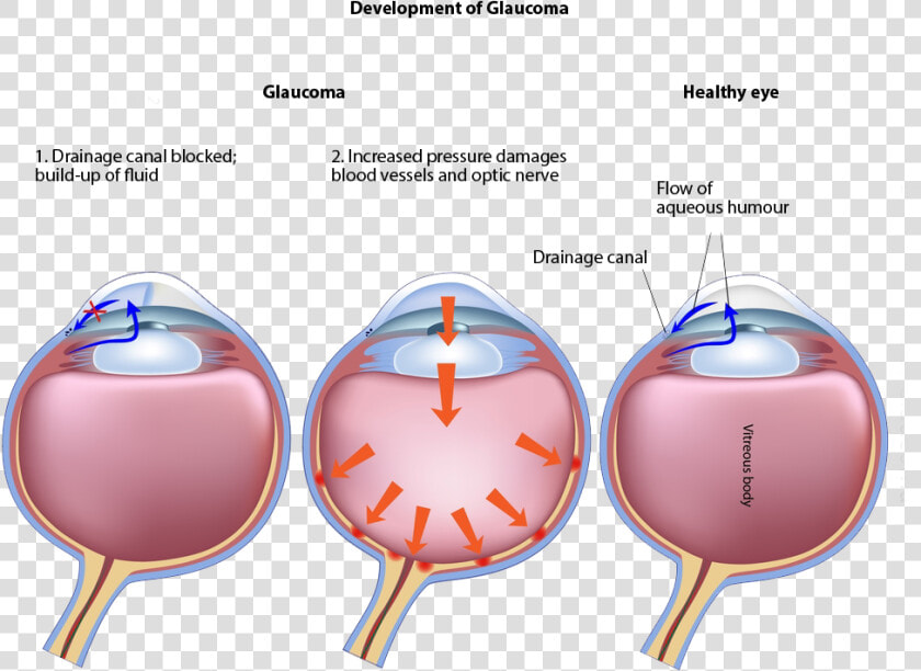 Development Of Glaucoma   Glaucoma Vs Healthy Eye  HD Png DownloadTransparent PNG