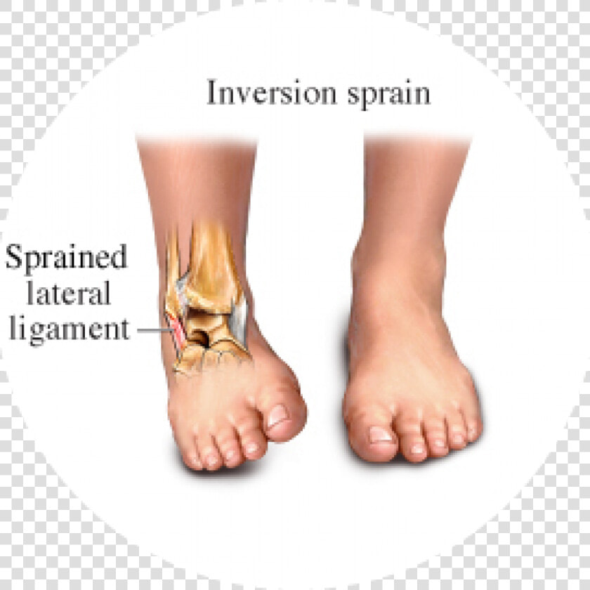 Hhg   Inversion Vs Eversion Ankle Sprain  HD Png DownloadTransparent PNG