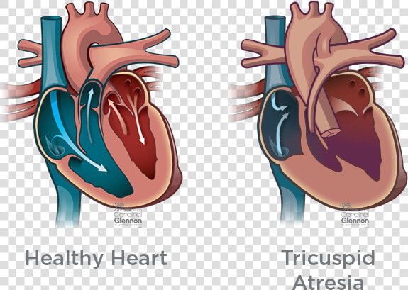 Tricusp atresia   Truncus Arteriosus Heart  HD Png DownloadTransparent PNG