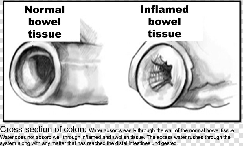 Inflamed Bowel  HD Png DownloadTransparent PNG