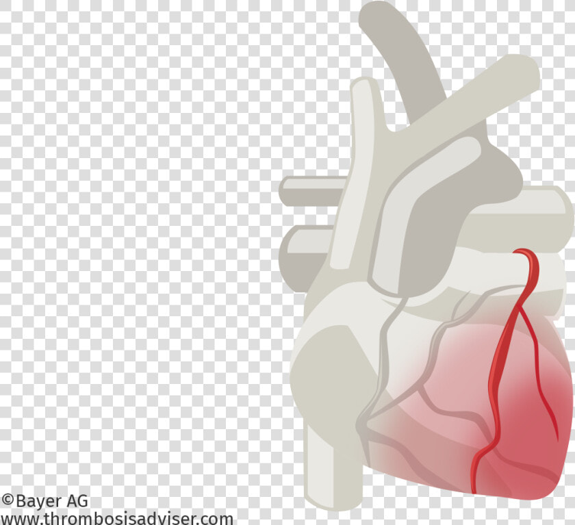 Cardiac Muscle Damage In Acs   Illustration  HD Png DownloadTransparent PNG