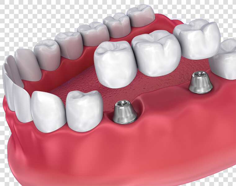 Implant supported Bridge   Dental Crown  HD Png DownloadTransparent PNG