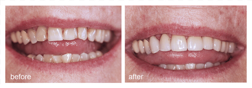 Shot Of Before And After Visiting Abington Smile Gallery   Mouth  HD Png DownloadTransparent PNG