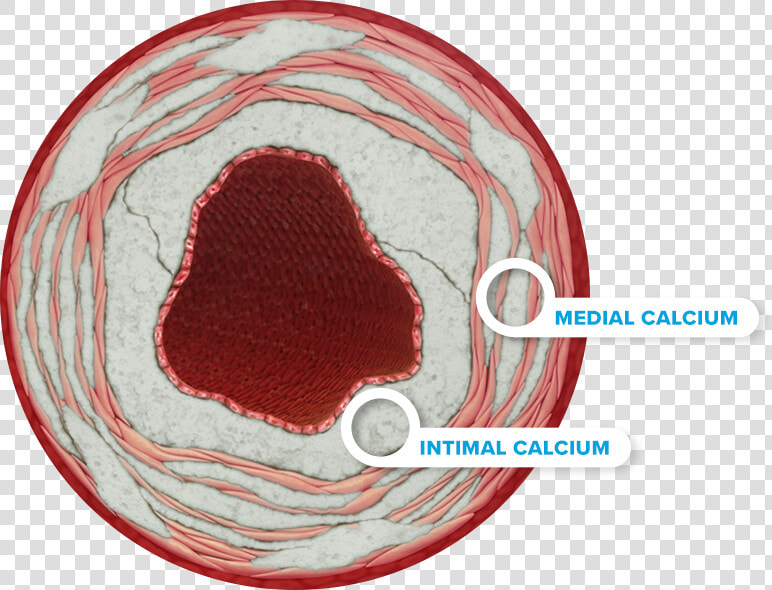 Calcium Right   Intimal Calcium  HD Png DownloadTransparent PNG