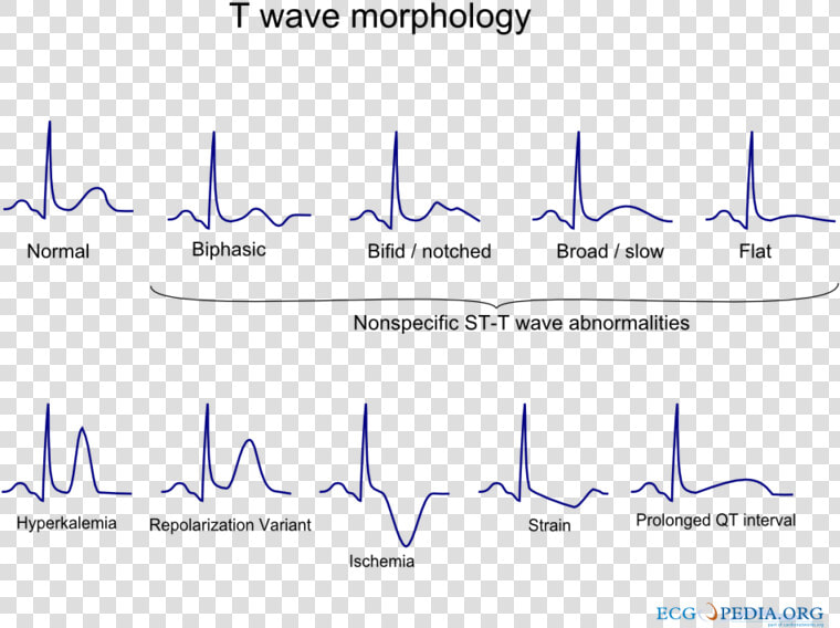 De t Wave Morphology   T Wave Morphology  HD Png DownloadTransparent PNG