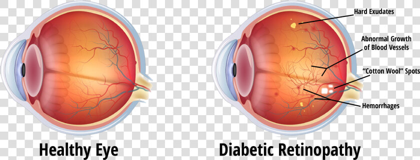 Eye During Diabetic Retinopathy  HD Png DownloadTransparent PNG