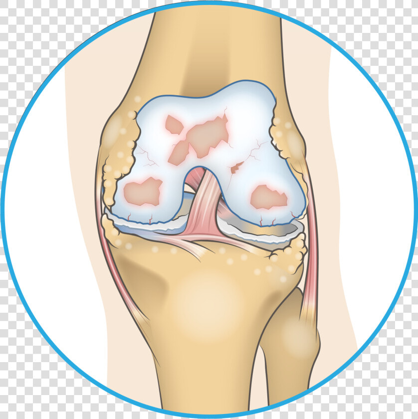 Bone Spur In Knee  HD Png DownloadTransparent PNG