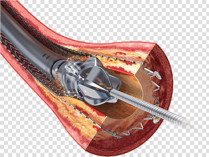 Stent Restenosis  HD Png DownloadTransparent PNG