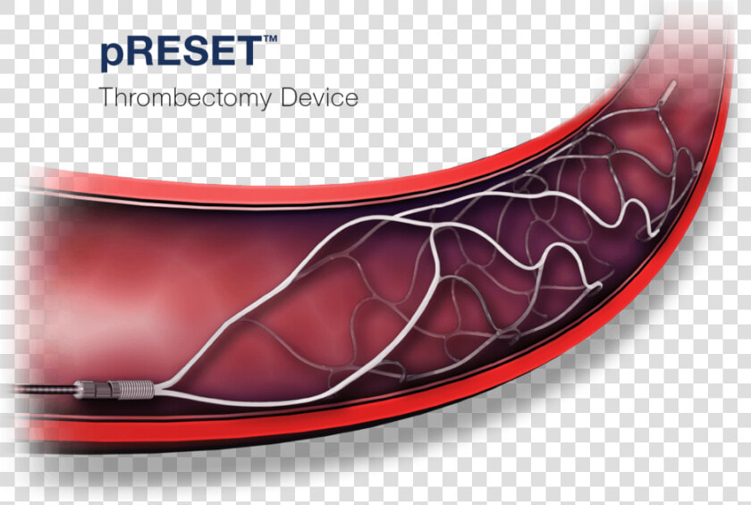 Phenox preset Thrombectomy Device  HD Png DownloadTransparent PNG