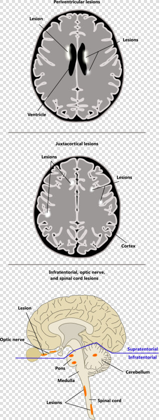 Periventricular Juxtacortical Infratentorial Spinal  HD Png DownloadTransparent PNG