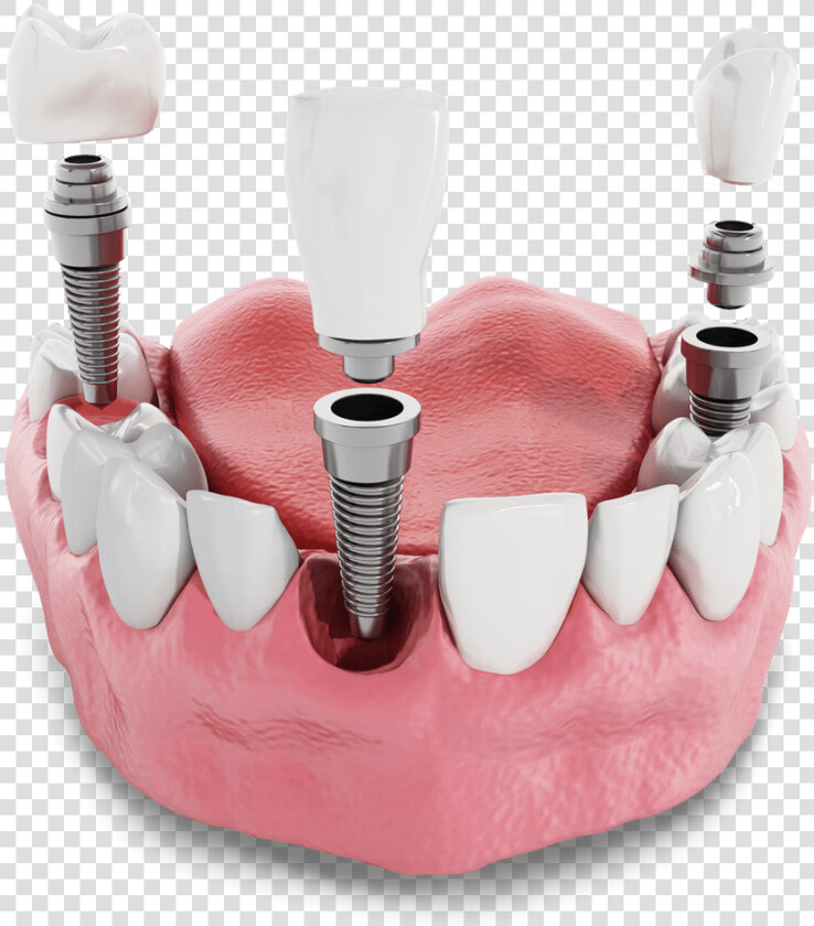 Dental Implant Model Kansas City  Mo   Implant Dentar Pret  HD Png DownloadTransparent PNG