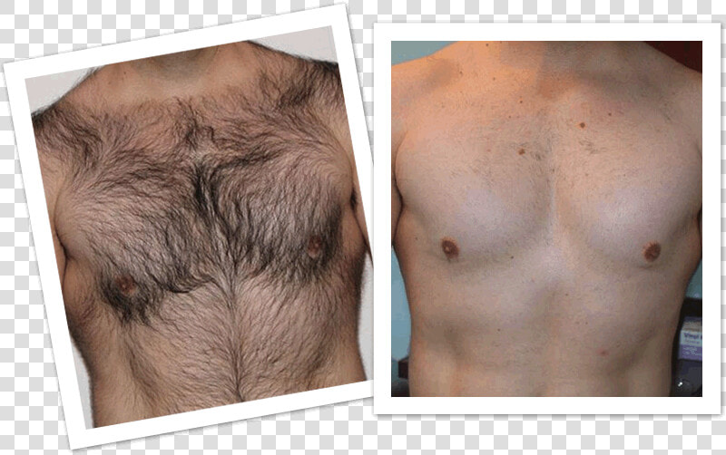 Mens Laser Hair Removal Before And After  HD Png DownloadTransparent PNG