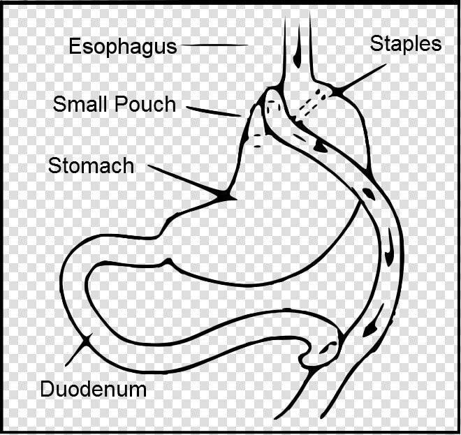 Roux En Y Gastric Bypass   Type Two Diabetes Drawing  HD Png DownloadTransparent PNG