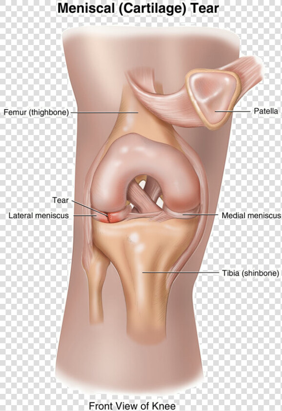 Can A Torn Meniscus Heal Itself   Loose Cartilage In Knee  HD Png DownloadTransparent PNG