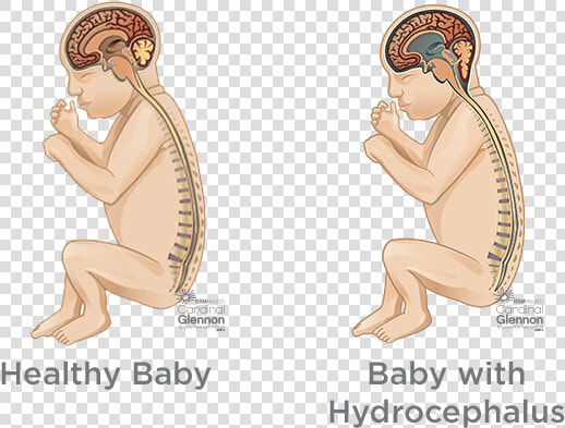 Hydrocephalus   Spina Bifida Before And After  HD Png DownloadTransparent PNG