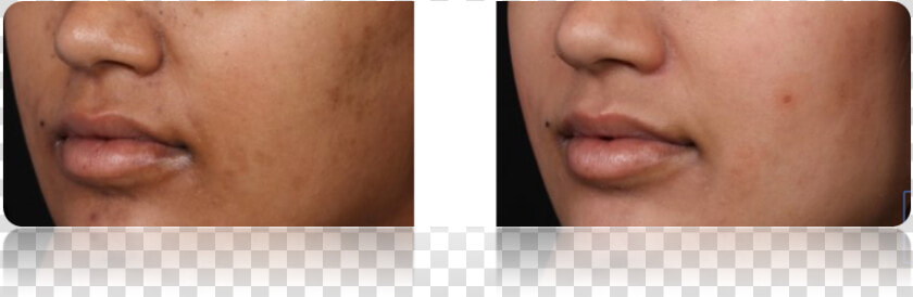 Acne   Scar  HD Png DownloadTransparent PNG