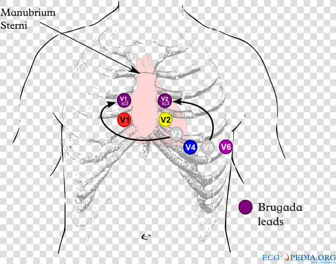 Brugada Syndrome Ecg Placement  HD Png DownloadTransparent PNG