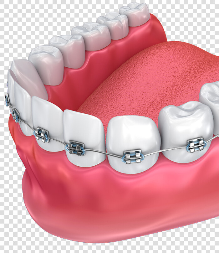 Haltom Orthodontics   Tooth Orthodontics Png  Transparent PngTransparent PNG