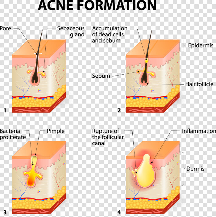 Acne Formation  HD Png DownloadTransparent PNG