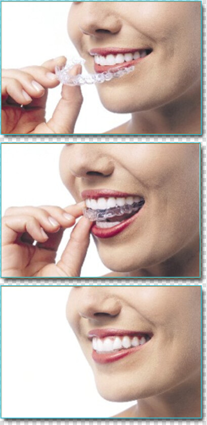 Invisalign   Someone With Clear Aligners  HD Png DownloadTransparent PNG