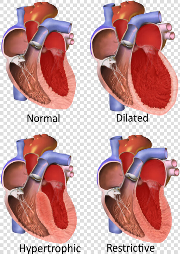 Major Categories Of Cardiomyopathy   Different Cardiomyopathies  HD Png DownloadTransparent PNG