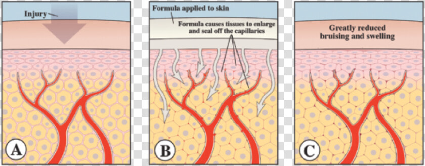 Bruise Repair Formula   Bruises How They Are Formed  HD Png DownloadTransparent PNG