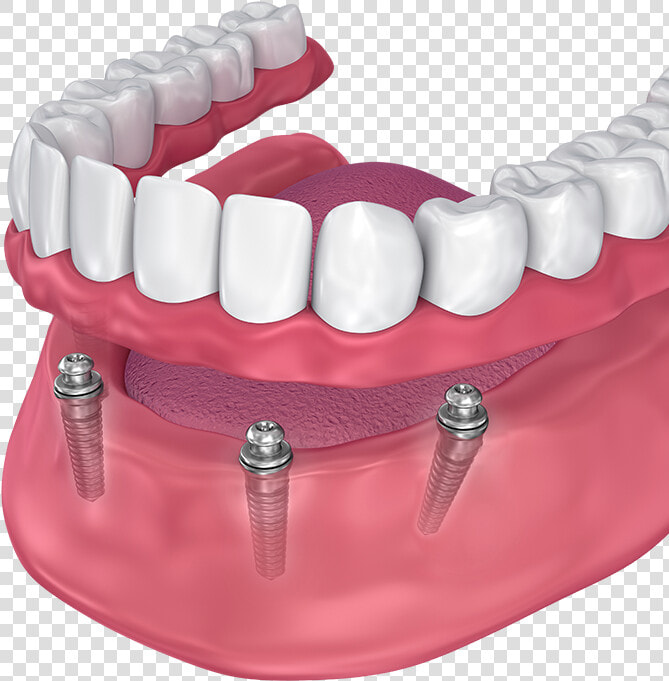 All On 4 Lower Denture   Implant Supported Denture  HD Png DownloadTransparent PNG