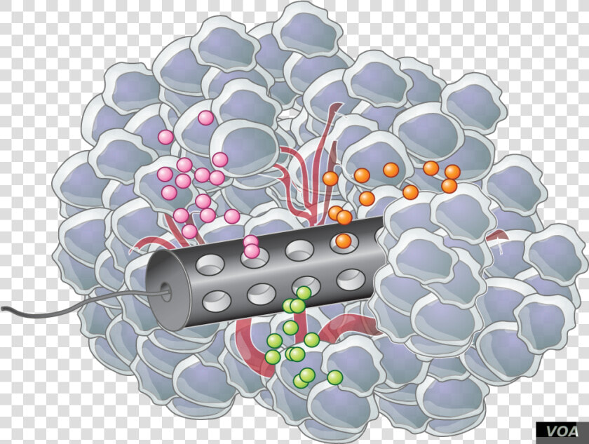 Placed In The Tumor  The Device Releases Microdoses   Implantable Therapeutic Cancer  HD Png DownloadTransparent PNG