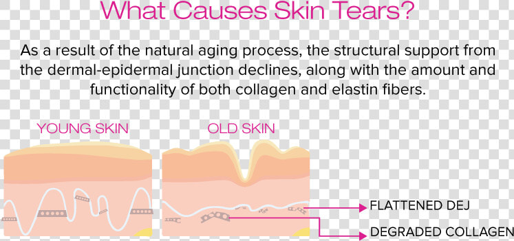 Amige 161110 What Causes Skin Tears   Dermal Epidermal Junction Aging  HD Png DownloadTransparent PNG