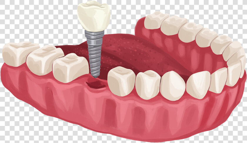 Dental Implant For Diabetics  HD Png DownloadTransparent PNG